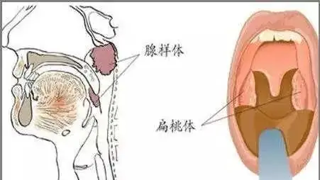 孩子张嘴睡觉用“封口贴”就行吗?医生给出的答案是什么?-第13张图片-百花生活百科知识分享 孩子张嘴睡觉用“封口贴”就行吗?医生给出的答案是什么?-第13张图片-百花生活百科知识分享