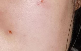 北京点痣最好的医院