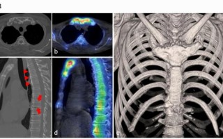 cdkl5综合症是什么病