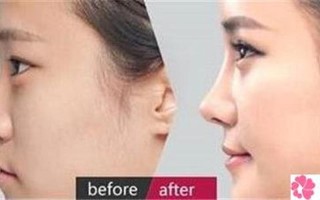 北京垫鼻子多少钱