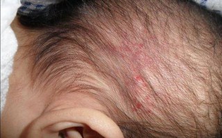 头皮痒甚至会起小疙瘩怎么办