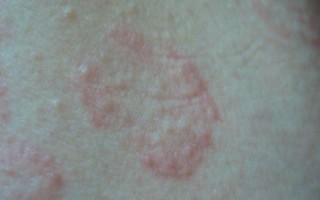 百度皮肤病图片识别